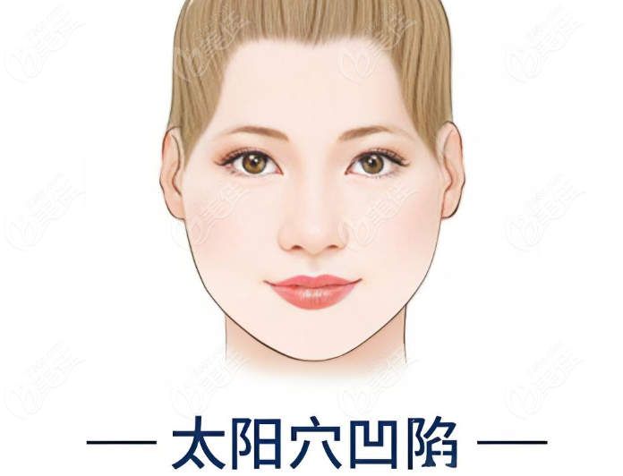 太阳凹陷怎样变饱满的妙招